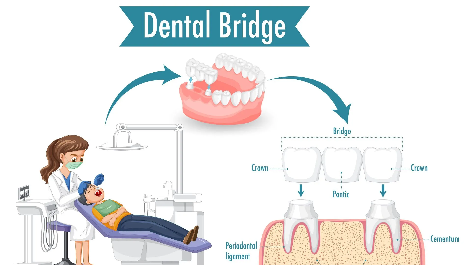 How long does a Dental Bridge last? - Roots Dental